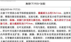 五次化免后多发淋巴结肿大