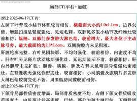 五次化免后多发淋巴结肿大