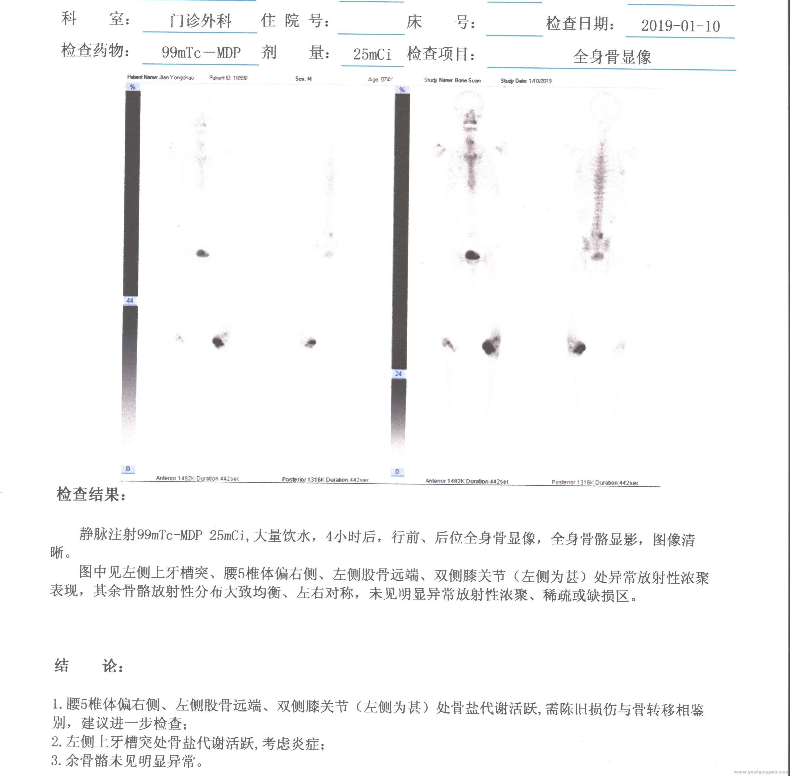 骨扫描201902.jpg